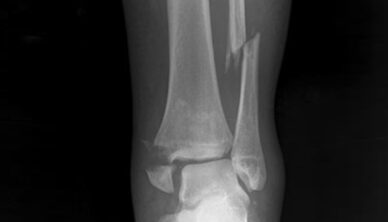 Xray of a Fracture
